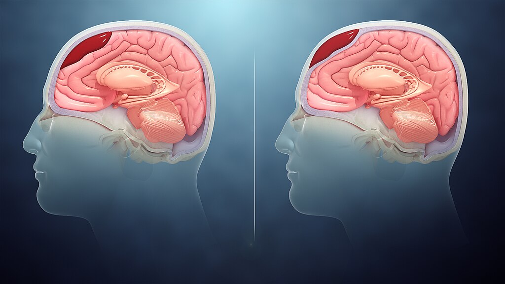 Epidural vs. Subdural Hematoma